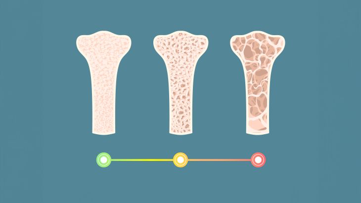 Osteoporosis progress, illustration. تطور هشاشة العظام