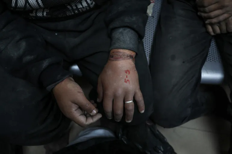 One of the Palestinian men arrested and tortured for days by Israeli soldiers shows the number he was marked with and his swollen hands from the handcuffs [Abdelhakim Abu Riash\Al Jazeera]