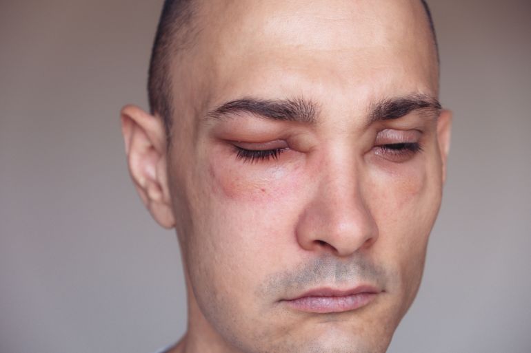 Caucasian man has angioedema around the eyes caused by allergic reaction to agents such as insect bites, ...