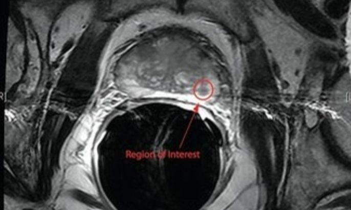 Prostate 3.0 Tesla MRI Image shows the Region of Interest (ROI)localizing the patient's disease. A subsequent biopsy confirmed cancer.